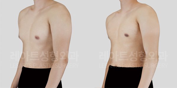 여유증 그레이드2-a 여유증 수술 전후 사진