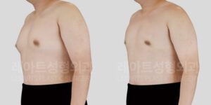 여유증 수술 후 전후사진