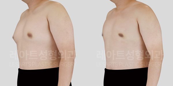 여유증 수술 후 전후사진