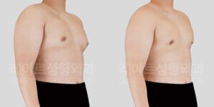 여유증 수술 후 전후사진