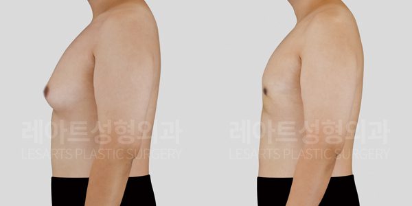 남성 여유증, 유선 제거 후 초기 관리가 중요한 이유(2개월 후)​