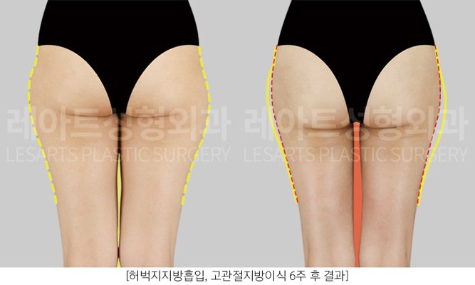 골반 지방이식 + 허벅지 지방흡입 전후사진