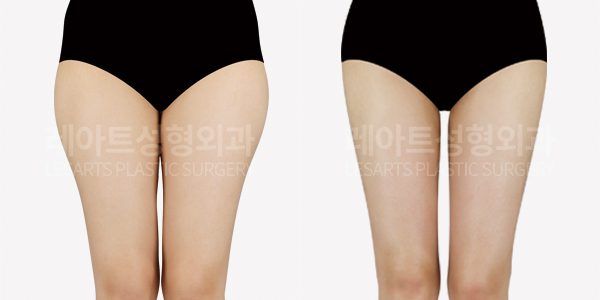 허벅지 지방흡입 전후사진 레아트 성형외과