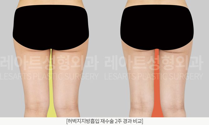 레아트 성형외과 다리 지방흡입 후면사진