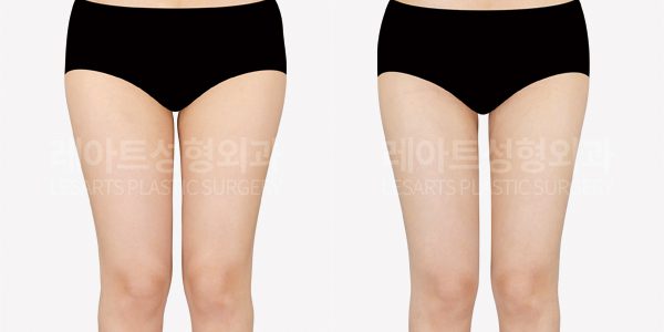 허벅지 지방흡입 전후사진 레아트 성형외과