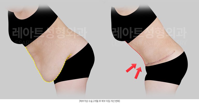 복부거상술 전후사진 레아트 성형외과
