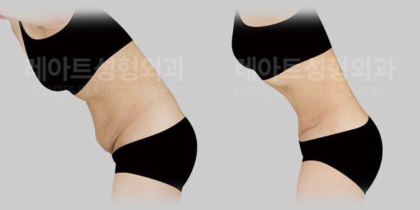 출산 후 복부거상 전후사진 레아트 성형외과