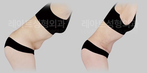복부거상 전후사진 레아트성형외과