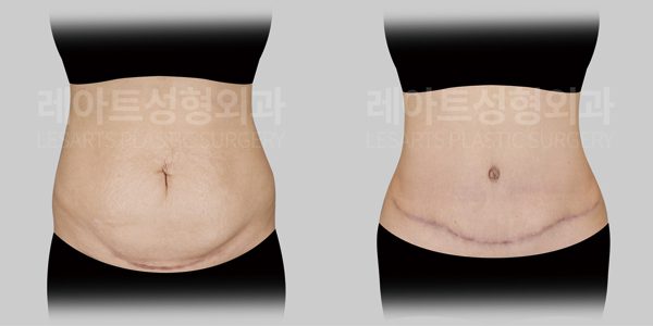 복부거상술 전후사진 레아트 성형외과