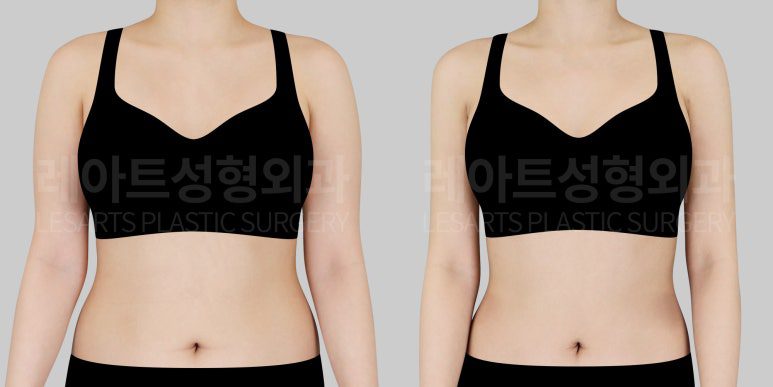 팔 지방흡입 전후사진