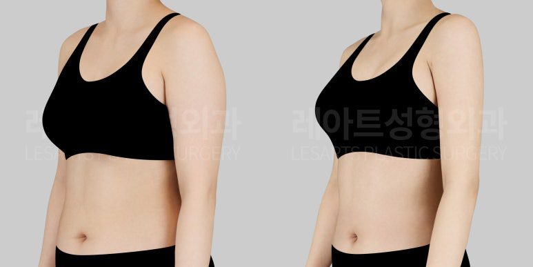 팔 지방흡입 전후사진
