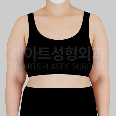 팔 지방흡입 전후사진 레아트 성형외과