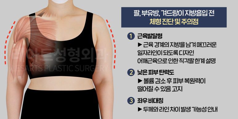 팔 지방흡입전 수술 플랜