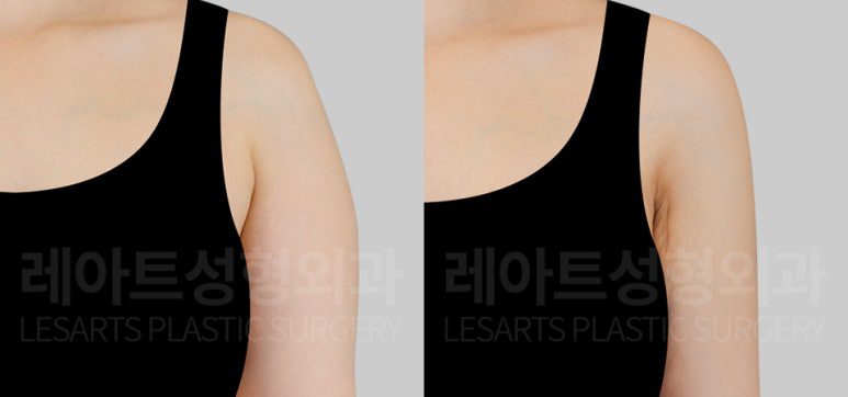 부유방 지방흡입 전후사진