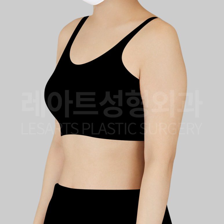 c-arm-liposuction-post17-04
