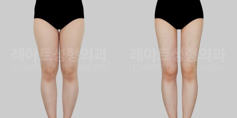 허벅지 지방흡입 : BMI 19, 마른 체형인데 허벅지만 고민이라면?