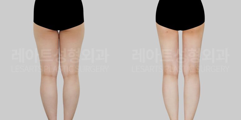 허벅지 지방흡입 전후사진