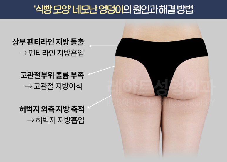 허벅지 지방흡입 & 고관절 이식 전후사진 레아트 성형외과