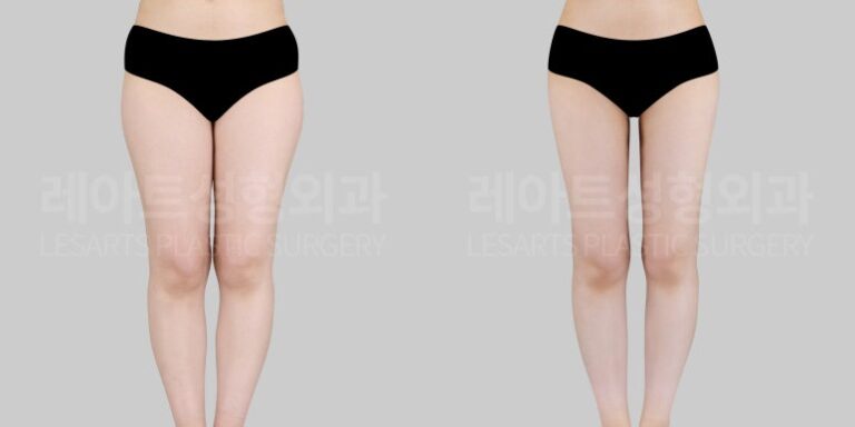 식빵 힙 원인과 개선 방법, 허벅지 지방흡입과 고관절 지방이식으로 둥근 힙라인 만드는 체형교정 사례