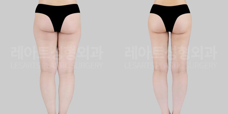 허벅지 지방흡입 & 고관절 이식 전후사진 레아트 성형외과