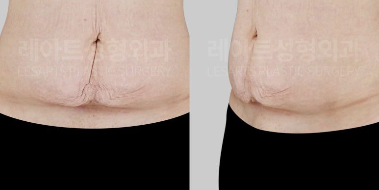 복부거상 전 하복부 처짐
