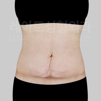 l-abdominoplasty-post09-02