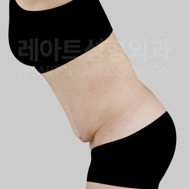 l-abdominoplasty-post09-03