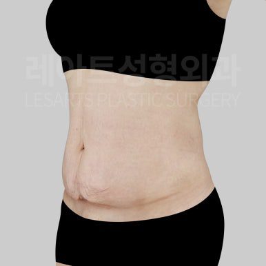 l-abdominoplasty-post09-04