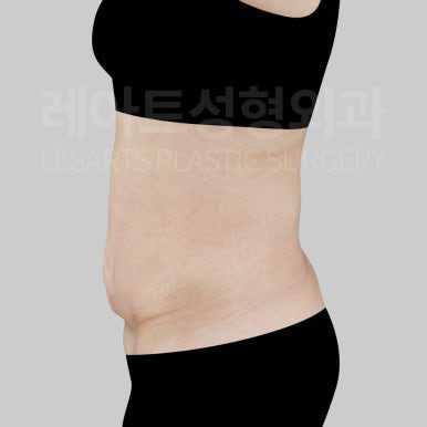 l-abdominoplasty-post09-05