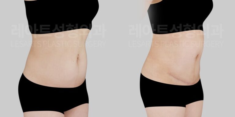 복부거상 전후사진 레아트 성형외과