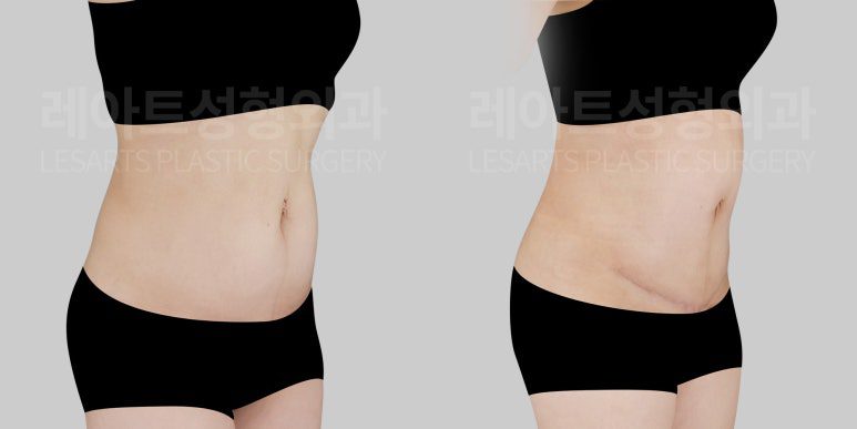 복부거상 전후사진 레아트 성형외과