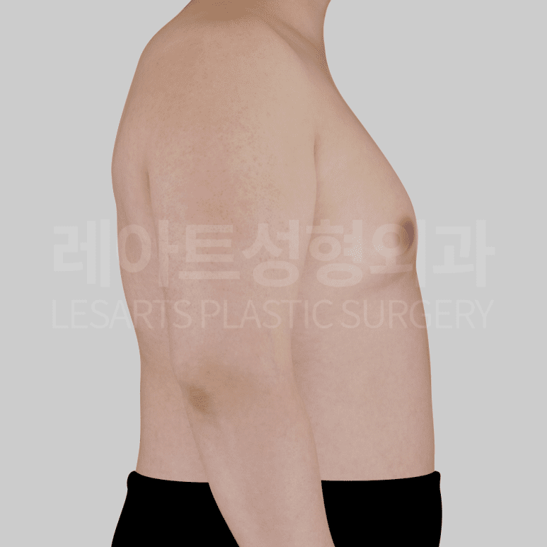 여유증 수술전