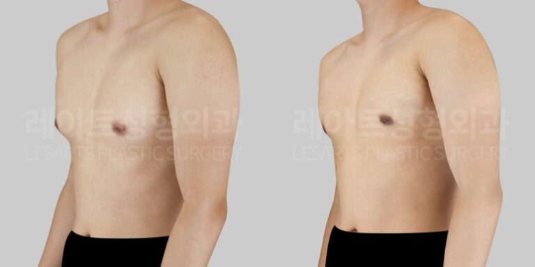 여유증 전후사진 레아트 성형외과