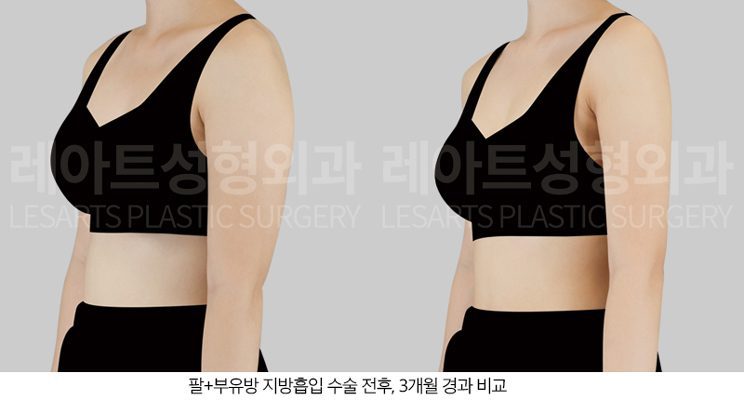 근육형 팔 지방흡입 전후사진