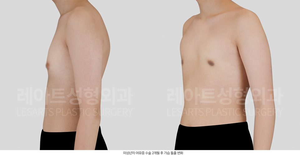 여유증 전후사진