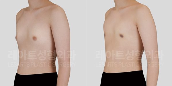 n-gynecomastia-post-199