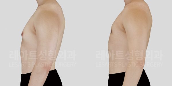 여유증 그레이드 a-2 전후사진