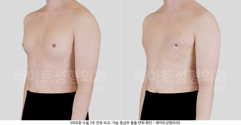 여유증 전후사진 레아트 성형외과