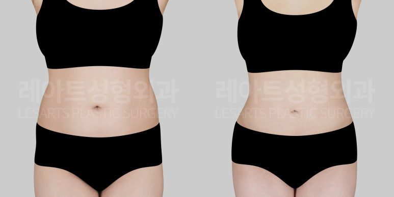 복부 지방흡입 전후사진 - 서용승 원장
