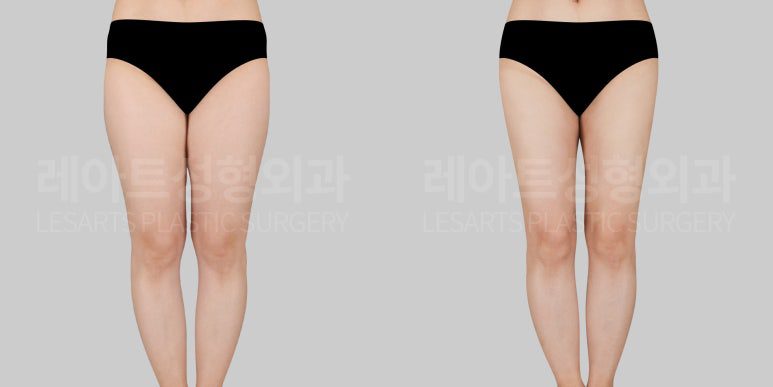 허벅지 지방흡입 전후사지