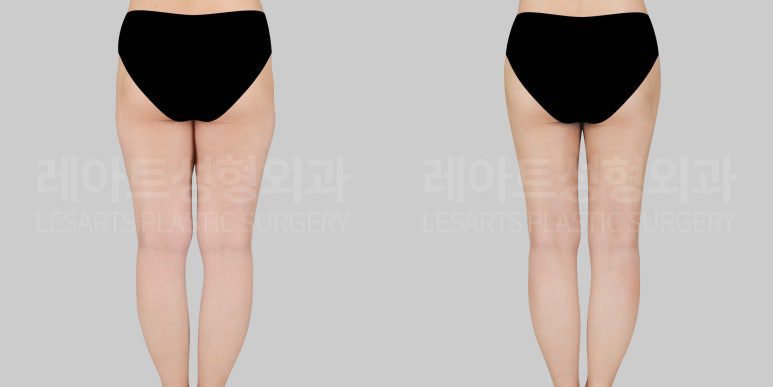 허벅지 지방흡입 전후사진