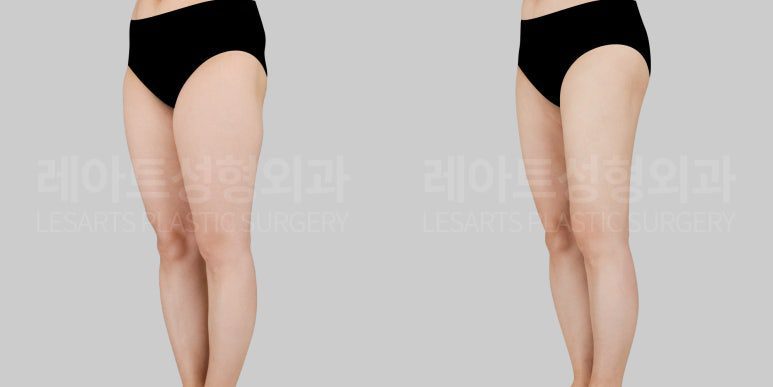 허벅지 지방흡입 정후사진