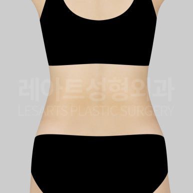 c-abdominal-liposuction-post18-02