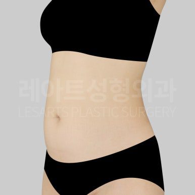 c-abdominal-liposuction-post18-03