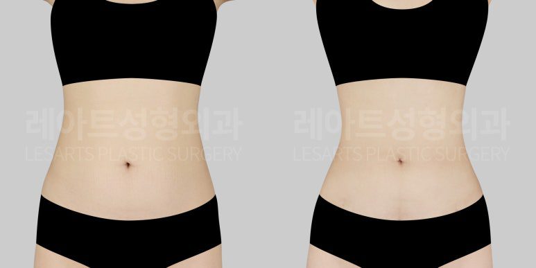 복부 지방흡입 전후 후기 - 레아트 성형외과