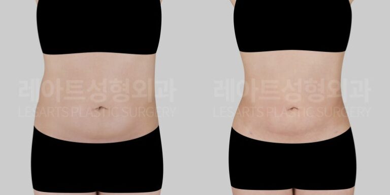 40대 복부 지방흡입 전후사진 비교 앞모습