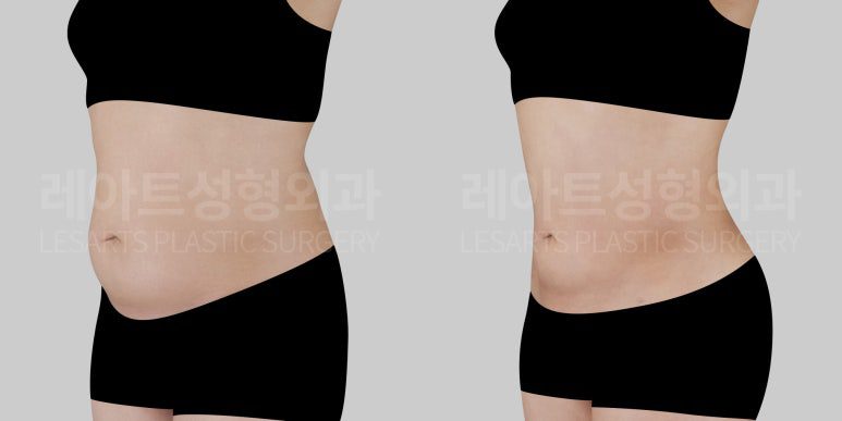 40대 복부지방흡입 전후사진 비교 옆모습