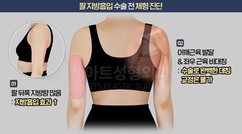 팔 지방흡입 수술 전 진단