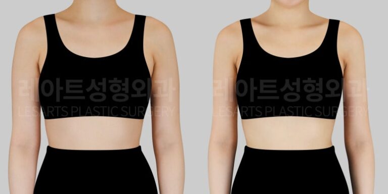 팔 지방흡입 후 앞모습 비교사진