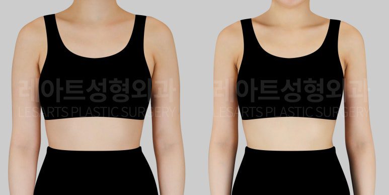 팔 지방흡입 후 앞모습 비교사진